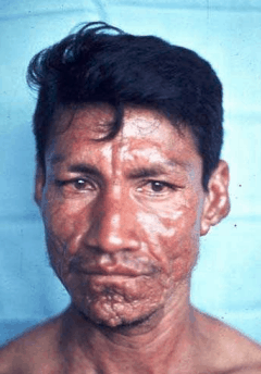 Immigrant leper