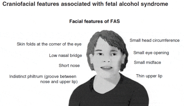Facial characteristics of a child with FAS